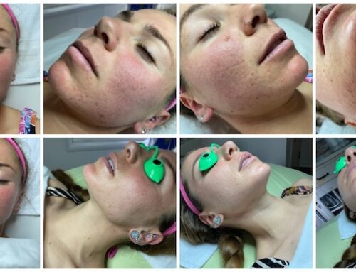 Featured Acne Treatment Galleries